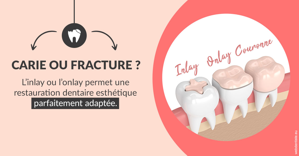 https://www.cabinetdentaireducentre.fr/T2 2023 - Carie ou fracture 2