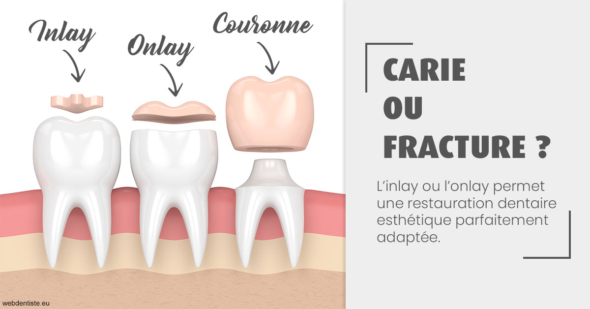 https://www.cabinetdentaireducentre.fr/T2 2023 - Carie ou fracture 1