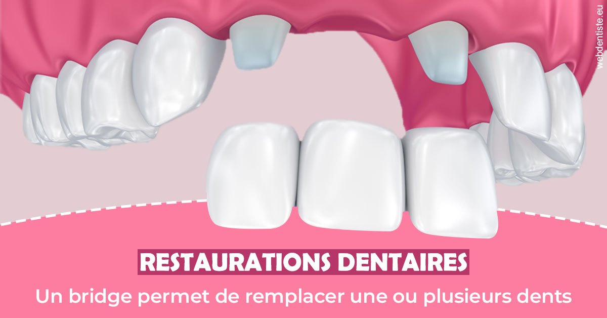 https://www.cabinetdentaireducentre.fr/Bridge remplacer dents 2