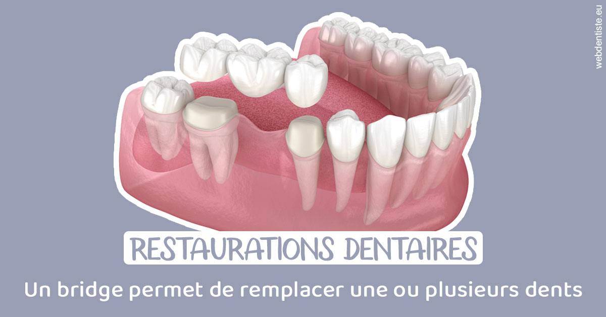 https://www.cabinetdentaireducentre.fr/Bridge remplacer dents 1