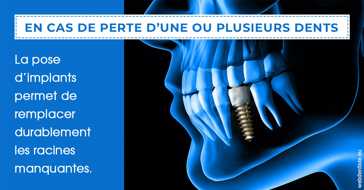 https://www.cabinetdentaireducentre.fr/2024 T1 - Implants 01
