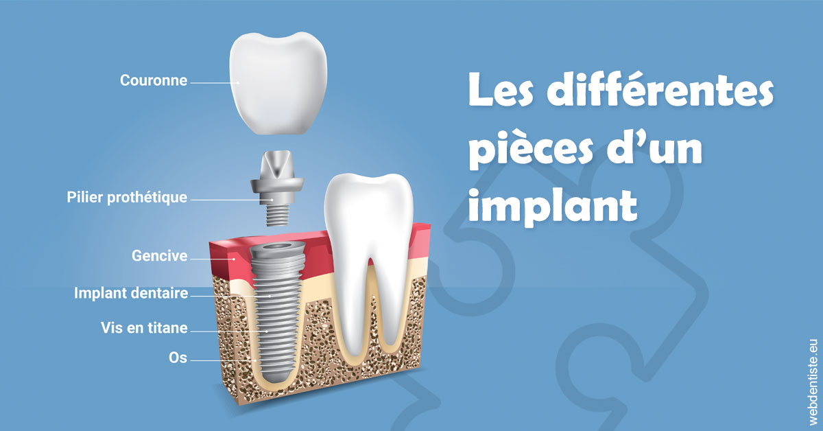 https://www.cabinetdentaireducentre.fr/Les différentes pièces d’un implant 1